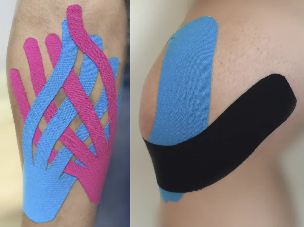 Kinesiotaping w fizjoterapia Poznań